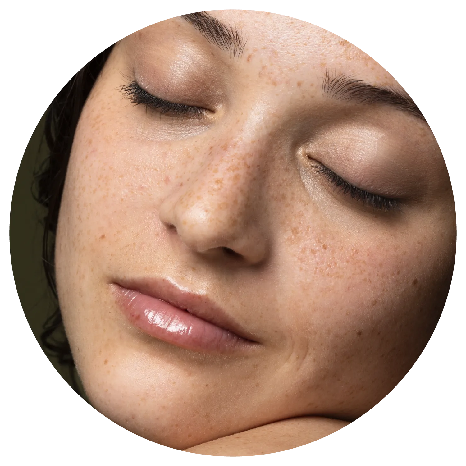 Age Spots treatment results at Toronto medical spa - The Chain Reaction of Symptoms